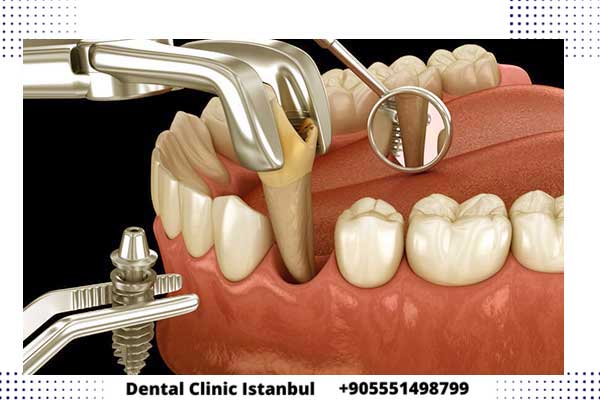أنواع زراعة الأسنان في تركيا – المراحل و أهم الأسئلة الشائعة