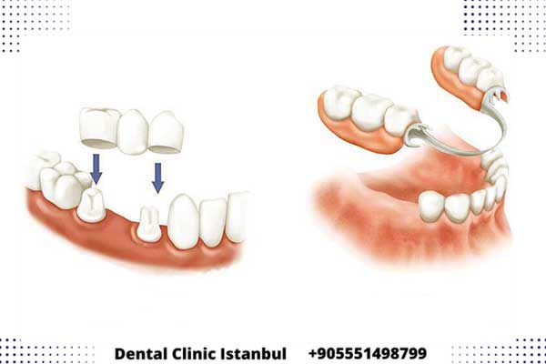 تقنيات علاج الاسنان في تركيا – أنواع علاجات الأسنان الأفضل عالميا