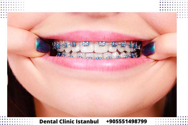 تقويم الاسنان في تركيا – التقنيات و الأنواع وطرق التركيب