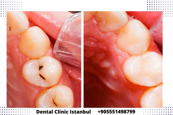 حشو الاسنان في تركيا – خيارات متعددة وطرق حديثة للعلاج