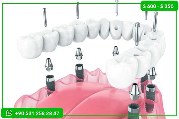 Best Dentist in Turkey