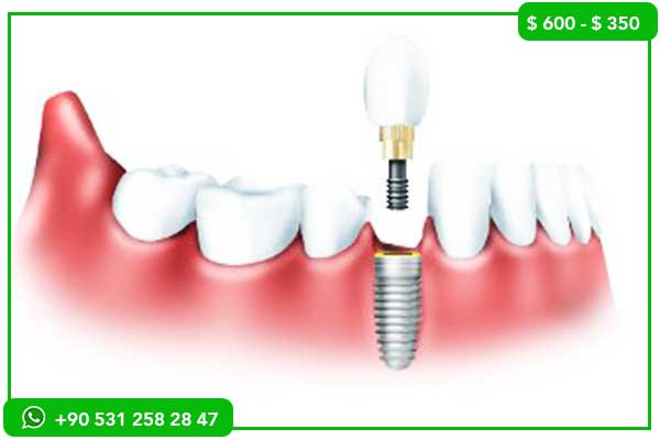 Best Dental Clinic in Turkey