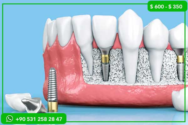 Dental Treatment Turkey