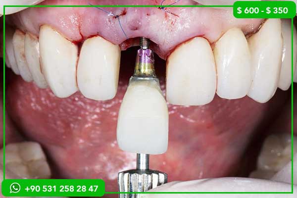 Transform Your Smile in Turkey