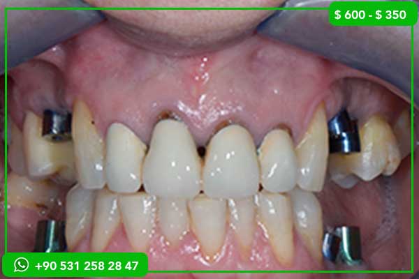 Dental Aesthetics Turkey