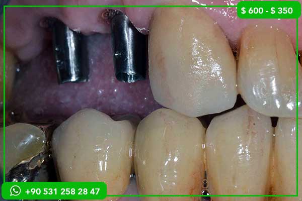 Dental Veneers in Turkey