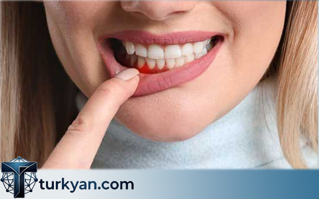 Is It Safe to Get Dental Implants in Turkey