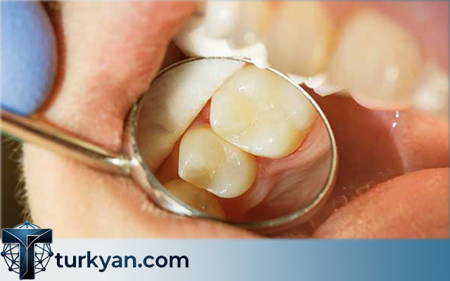 how long does dental implants take in turkey