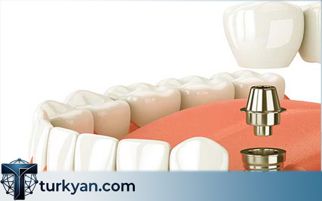 dental holiday in turkey istanbul