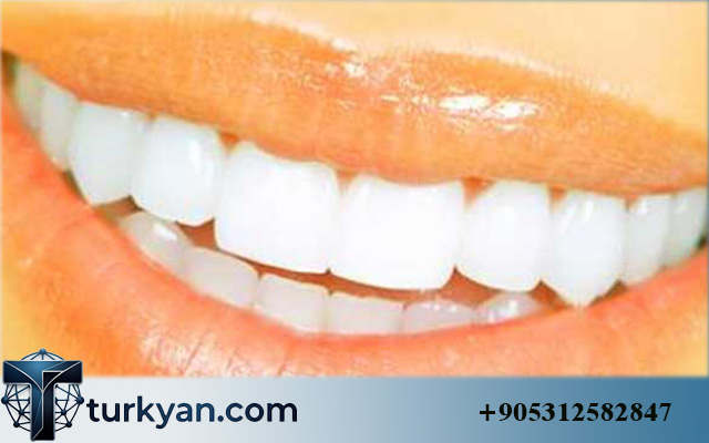 dental implant cost turkey